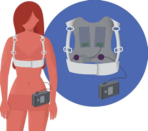 Outpatient treatment with the wearable cardioverter defibrillator 